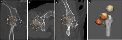 Fractured morphology of femoral head associated with  - Frontiers